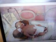 Bayi Kembar Siam di Tegal Berisiko Tinggi