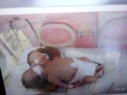 Bayi Kembar Siam di Tegal Akhirnya Meninggal