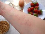 Tips Agar Tidak Alergi Pada Makanan