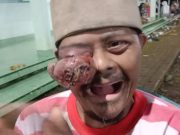 Derita Solekan yang Matanya Diserang Tumor Ganas, Siapa Mau Peduli ?