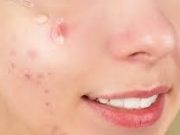 Tips Mudah Hilangkan Bekas Jerawat