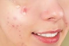 Tips Mudah Hilangkan Bekas Jerawat