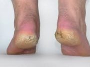 Tips Menghaluskan Kulit Kaki Karena Kering dan Pecah Pecah