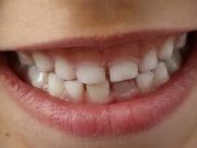 Tips Gigi Berlubang