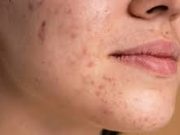 Tips Hilangkan Jerawat Secara Alami