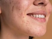 Tips Hilangkan Noda Bekas Jerawat