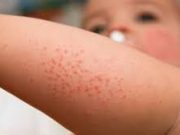 Tips Menghilangkan Ruam Pada Kulit Bayi