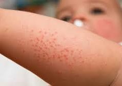 Tips Menghilangkan Ruam Pada Kulit Bayi