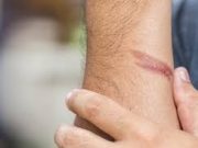 Tips Bersihkan Bekas Luka Bakar