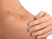 Tips Bersihkan Noda Bekas Luka Gores