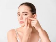 Tips Membersihkan Jerawat Secara Alami