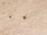 Tips Hilangkan Kutil Dengan Cepat dan Aman
