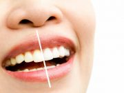 Ini 4 Tips Efektif Mengembalikan Gigi Putih Dengan Bahan Alami