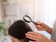 Selain Lidah Buaya, Ini 4 Tips Menghilangkan Ketombe Menggunakan Alami