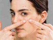 Tips Wajah Mudah Berjerawat