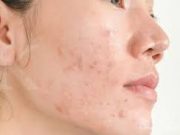 Tips Menghilangakan Bekas Jerawat
