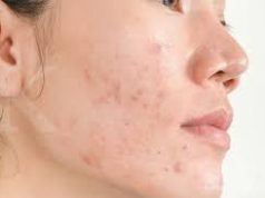 Tips Menghilangakan Bekas Jerawat
