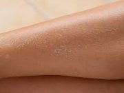 Tips Melembabkan Kulit Kering