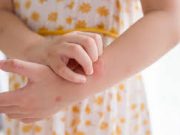 Tips Hilangkan Gatal Akibat Gigitan Nyamuk