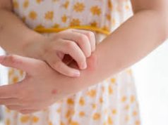 Tips Hilangkan Gatal Akibat Gigitan Nyamuk