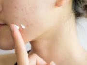 Tips Menghilangkan Bekas Jerawat Secara Alami