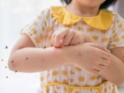Membuat Kurang Percaya Diri, 7 Tips Menghilangkan Bekas Gigitan Nyamuk yang Mudah Dilakukan