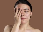 Tips Menghilangkan Bekas Jerawat