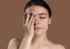 Tips Menghilangkan Bekas Jerawat