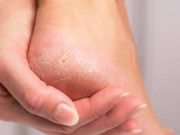Agar Tak Semakin Parah, Ini Empat Tips Mengatasi Kulit Tumit Kaki yang Pecah-pecah