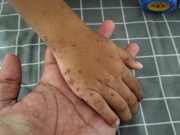 Flu Singapura Merebak di Batang, Ini Gejalanya