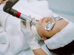 Perlukah Laser untuk Menghilangkan Flek Hitam di Wajah?