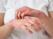 Ini Tiga Penyebab atau Kebiasaan yang Dapat Menularkan Herpes