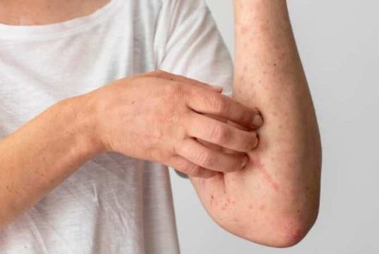 Menggaggu Aktivitas Harianmu? Ini Tiga Tips Mudah Mengatasi Gatal Akibat Biduran