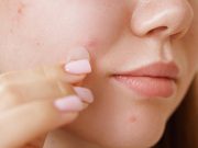 Tips Perawatan agar Jerawat Tak Tumbuh Lagi, Simak!
