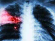 Pemerintah Dorong Perluasan Desa Siaga TB di Seluruh Indonesia